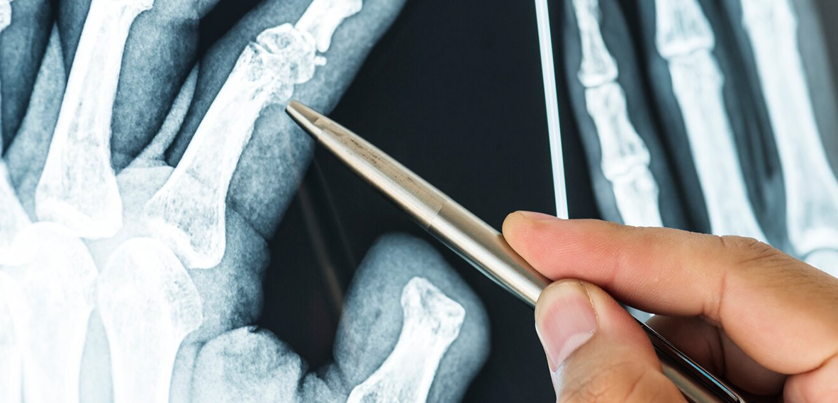 A Complete Guide to Understanding Fractures: Types, Symptoms, Treatment Options, and Recovery